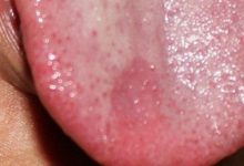 舌頭上潰瘍?cè)趺粗?舌頭上的潰瘍?cè)趺粗伪容^好-大智網(wǎng)匯