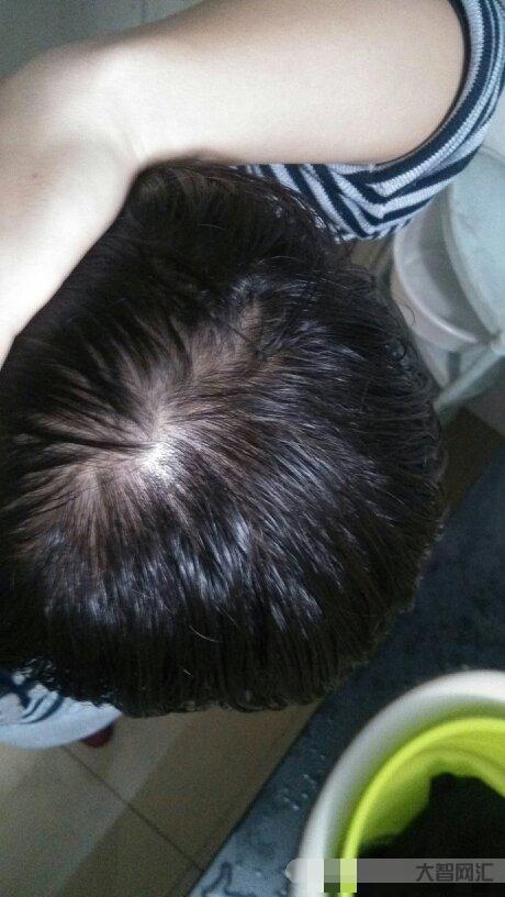 頭發稀疏怎么恢復