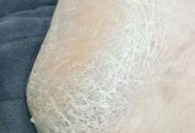 腳后跟干裂起硬皮是什么原因-腳后跟粗糙起硬皮是病嗎-大智網匯