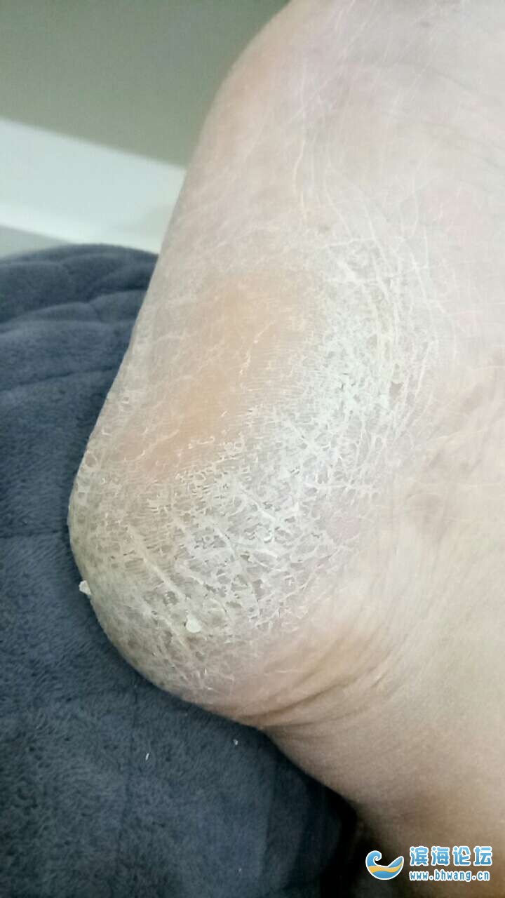 腳后跟干裂起硬皮是什么原因