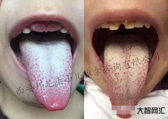 舌頭上有白苔是什么原因