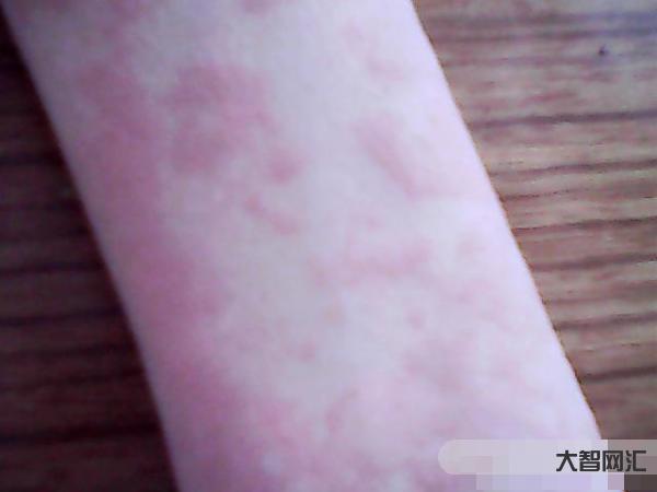 2、身體過敏怎么辦？