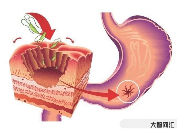 1、胃潰瘍的早期癥狀是什么？胃潰瘍的癥狀是什么？