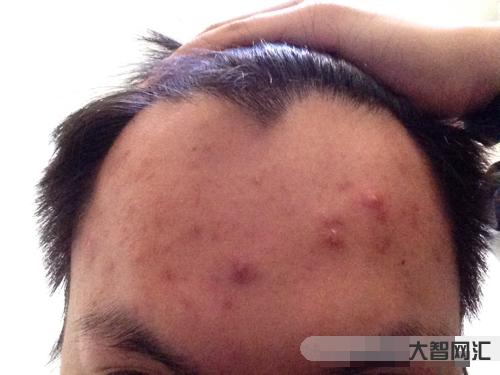 2、額頭上長痘痘的原因是什么?