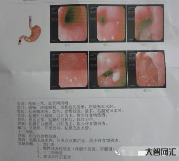 1、胃病的癥狀是什么？