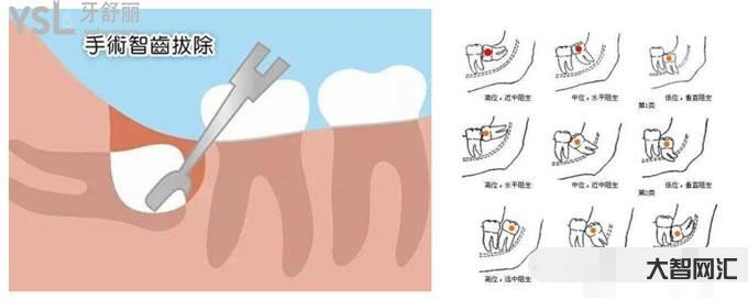 1、立事牙有問題,一定要拔掉嗎?