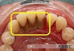 1、如何在家有效去除牙結(jié)石?