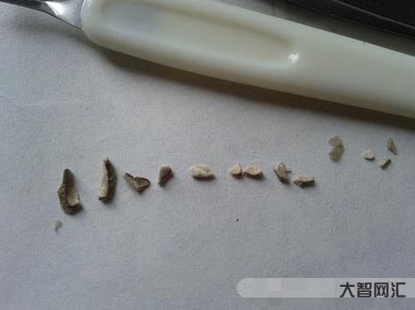 牙結石什么成分組成最多-“牙結石”可以用手摳掉嗎?教你一招，牙縫里的臟