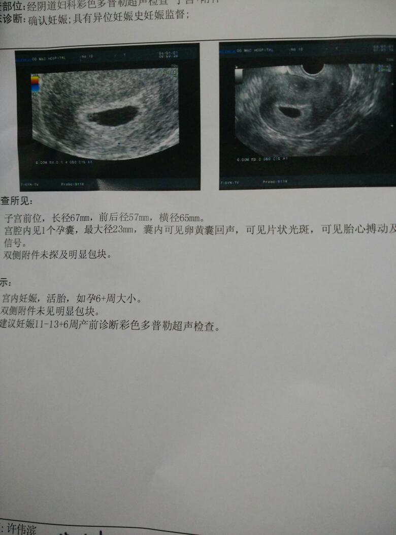 寶寶沒有動胎心正常嘛怎么辦-很多的孕媽被告知寶寶沒有胎心，往往與這些原