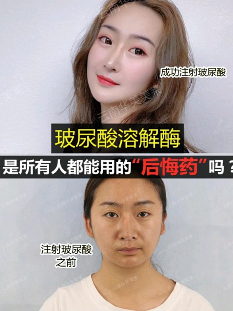 玻尿酸為什么不會溶解-真相來了|玻尿酸真如“他們”說的那般安全嗎? 玻尿酸為什么不會溶解-真相來了|玻尿酸真如“他們”說的那般安全嗎?