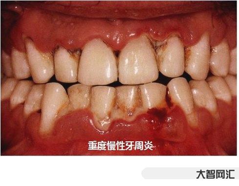 牙齒間歇性串著疼痛-莫名其妙的牙痛是病嗎?