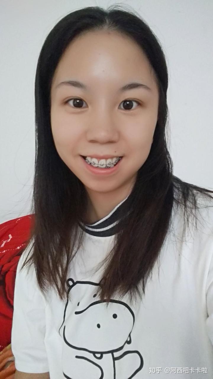 有一副牙套只戴了五天-疫情時牙套遇到突發(fā)情況怎么辦?應(yīng)對辦法在這里