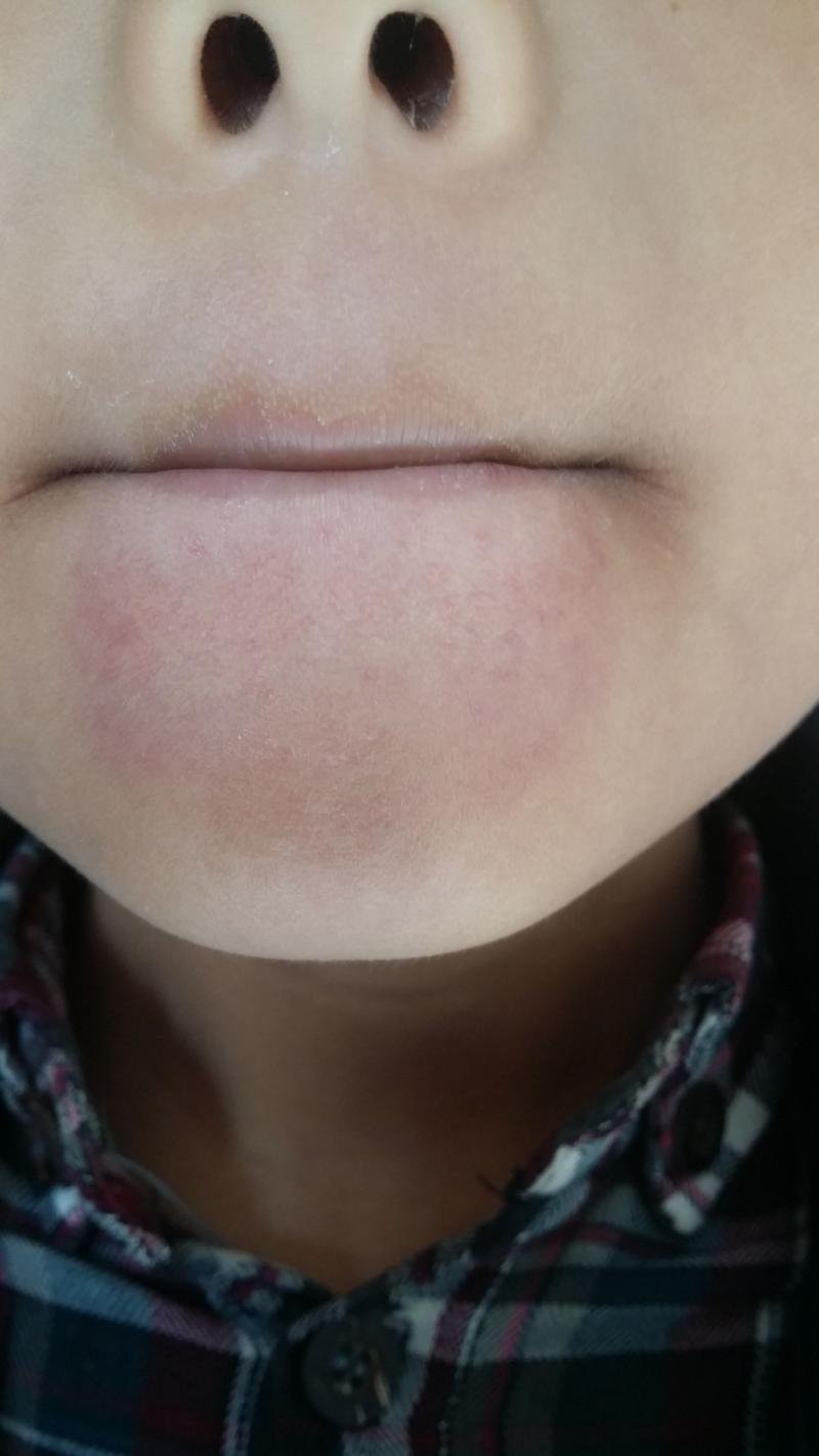 下巴上突然有凹陷-面中部凹陷、下巴很長，像朱元璋這種“豬腰子臉”還能拯