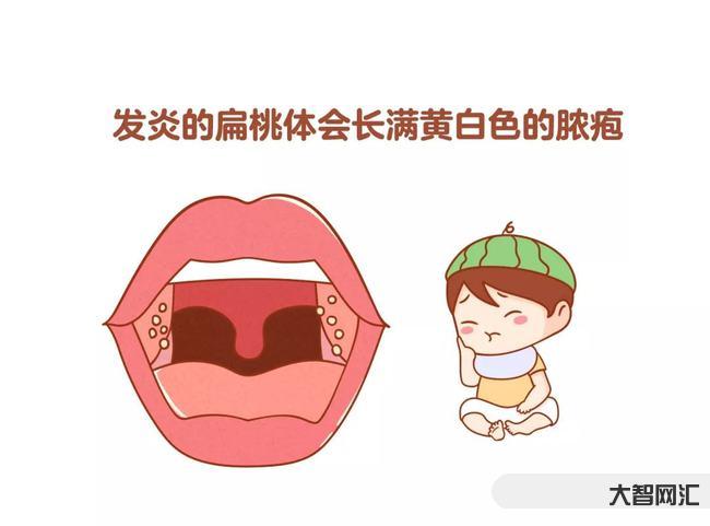 急性化膿性扁桃體炎-扁桃體腫大、表面化膿,一定是扁桃體炎嗎? 急性化膿性扁桃體炎-扁桃體腫大、表面化膿,一定是扁桃體炎嗎?