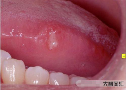 舌頭上潰瘍怎么治-有一種劇痛叫“口腔潰瘍”，補充維C不管用，3種方法更