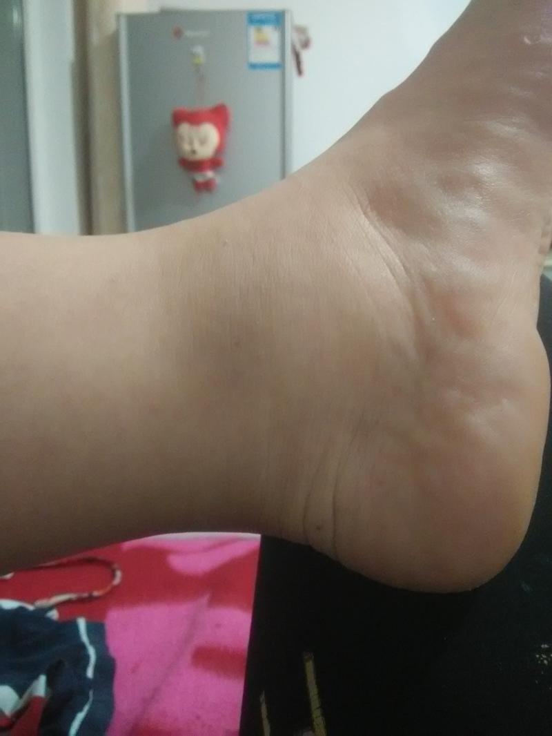 腳踝浮腫是什么原因引起的-孕期腳腫如“面包”，只是因為喝水喝多了?和很