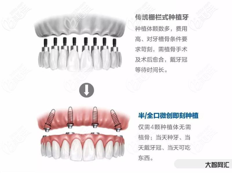 種牙多少錢一顆啊-集采落地后種牙怎么選?種一顆牙便宜多少錢? 種牙多少錢一顆啊-集采落地后種牙怎么選?種一顆牙便宜多少錢?