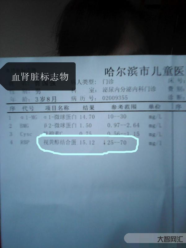 糖化血紅蛋白高是什么意思-關(guān)于糖化血紅蛋白,必須繞開這5個(gè)誤區(qū) 糖化血紅蛋白高是什么意思-關(guān)于糖化血紅蛋白,必須繞開這5個(gè)誤區(qū)