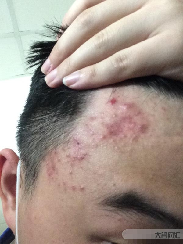 額頭長痘痘怎么快速去除-快速消除額頭痘痘方法