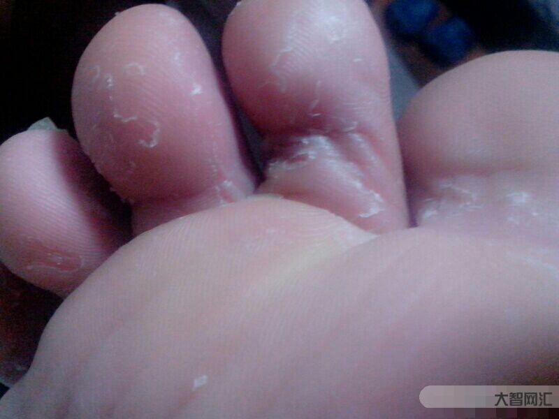 腳氣爛腳趾縫癢潰爛怎么治-用于治療腳氣的11種外用藥 腳氣爛腳趾縫癢潰爛怎么治-用于治療腳氣的11種外用藥