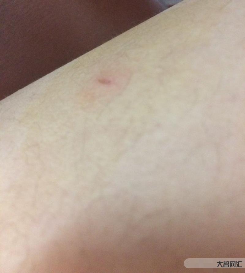 被貓抓了一下輕微破皮要打針嗎-被自己養(yǎng)的貓咪抓傷了、破皮了，該怎么處理