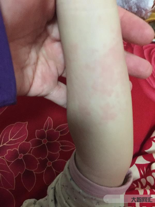 身上起紅色疙瘩很癢怎么回事-皮膚風團 蕁麻疹你曉得咋回事嗎?