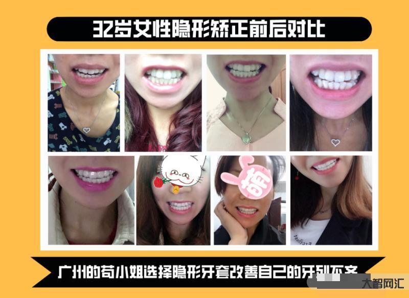 牙套價(jià)格一般是多少錢(qián)一個(gè)-300塊的牙套和三萬(wàn)塊的種植牙，到底有什么區(qū)