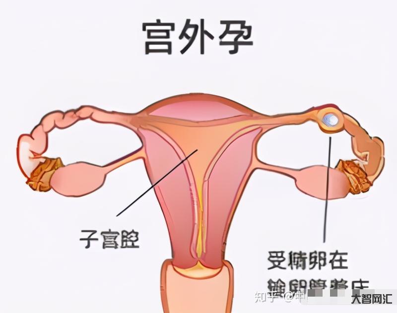 宮外孕的癥狀有哪些表現-醫生提醒:孕婦有這2個異常，是宮外孕的表現，要