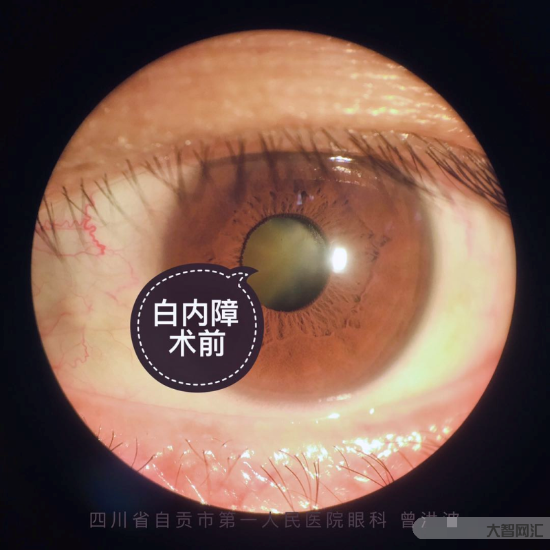 白內(nèi)障的主要癥狀是什么-白內(nèi)障患者的常見(jiàn)癥狀表現(xiàn) 白內(nèi)障的主要癥狀是什么-白內(nèi)障患者的常見(jiàn)癥狀表現(xiàn)