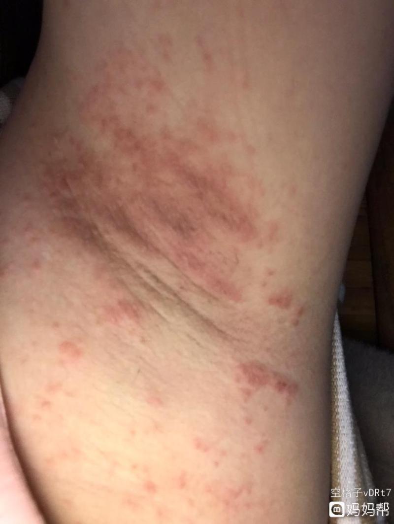 腋下有小疙瘩是什么原因-脖子和腋下的“小肉粒”是什么?能用手摳掉嗎?看