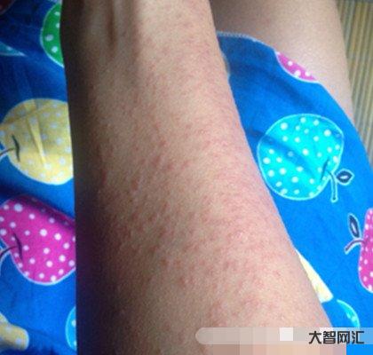 過敏了怎么辦最快方法-皮膚瘙癢怎么辦?教你解決這7種皮膚瘙癢的好方法