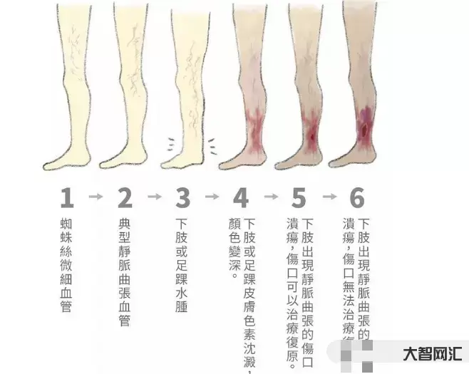 靜脈曲張是什么原因引起的-靜脈曲張是怎么引起的?從事這些工作的人要引起 靜脈曲張是什么原因引起的-靜脈曲張是怎么引起的?從事這些工作的人要引起