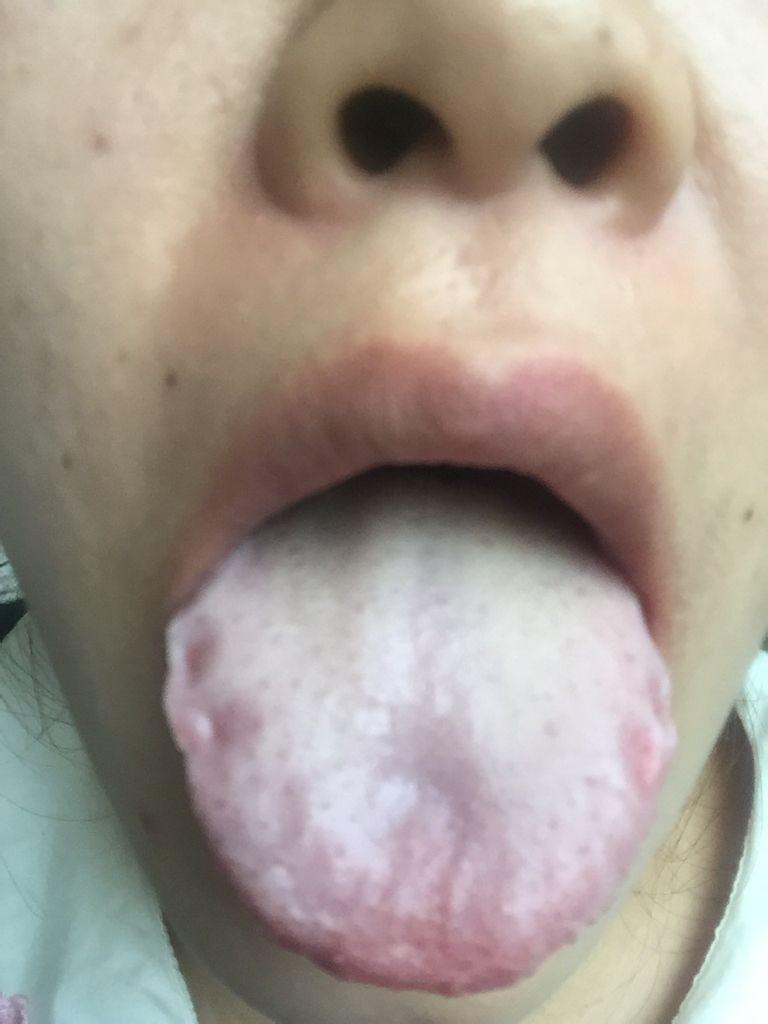 舌苔發黃厚膩是什么原因怎么調理-舌苔發黃、厚膩，要不要刮了它?看完你就