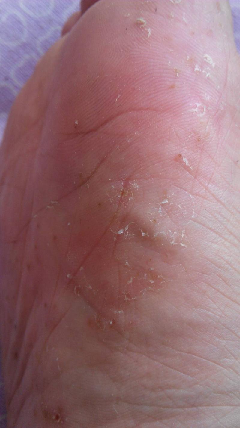腳上起小水泡很癢是怎么回事-夏季手腳長水泡、發癢，還脫皮?可能是汗皰疹