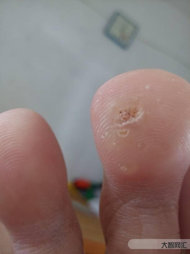 雞眼怎么治能徹底根除-手上有雞眼怎么除去? 雞眼怎么治能徹底根除-手上有雞眼怎么除去?