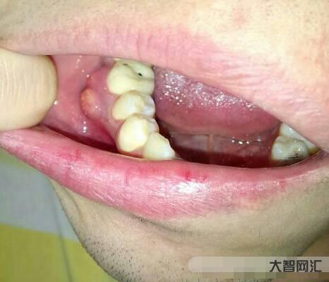 牙齦發(fā)炎腫痛怎么消炎最快-牙齦腫痛,吃什么藥最管用? 牙齦發(fā)炎腫痛怎么消炎最快-牙齦腫痛,吃什么藥最管用?
