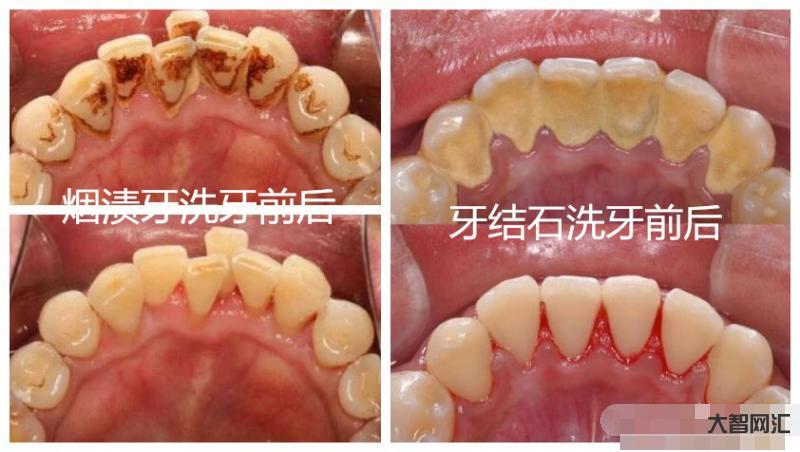 洗牙齒有什么好處和壞處-“洗牙”對牙齒有傷害嗎?醫生:6類人群盡量別洗 洗牙齒有什么好處和壞處-“洗牙”對牙齒有傷害嗎?醫生:6類人群盡量別洗